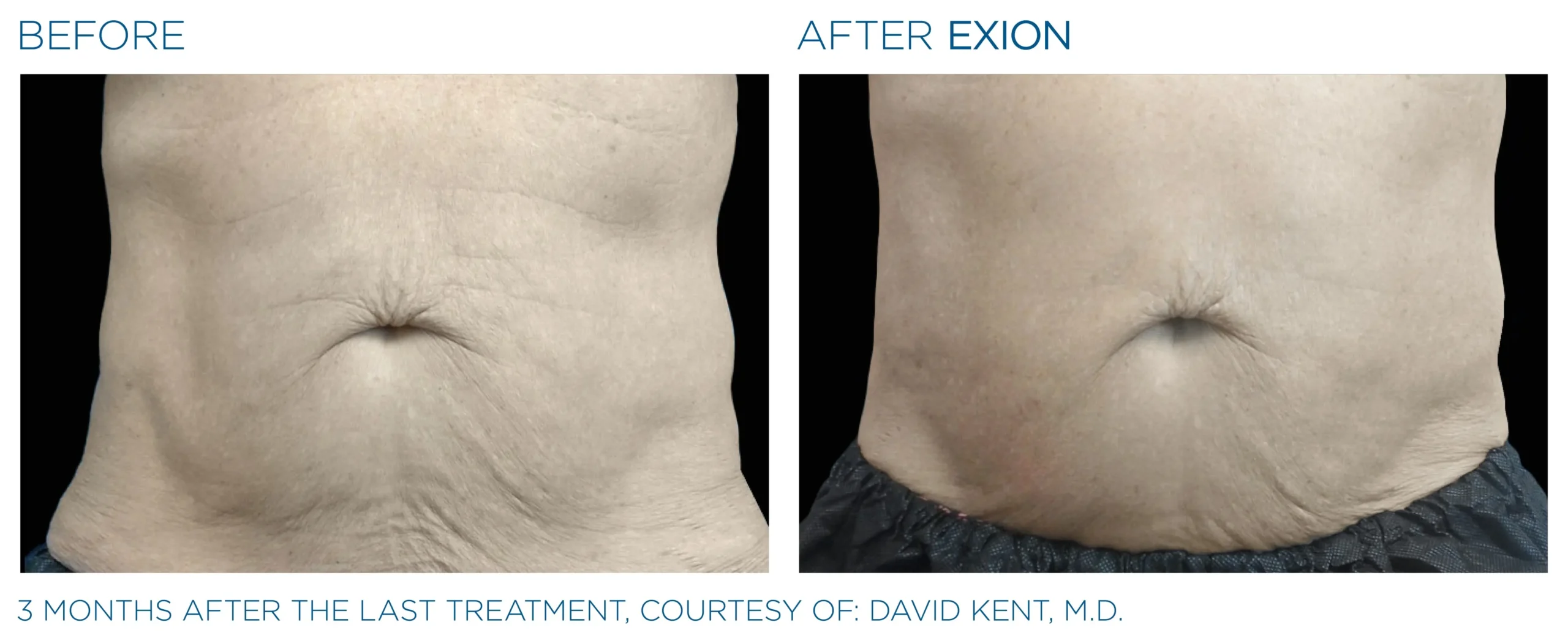 Manufacturer-provided EXION Body abdomen before and after result example
