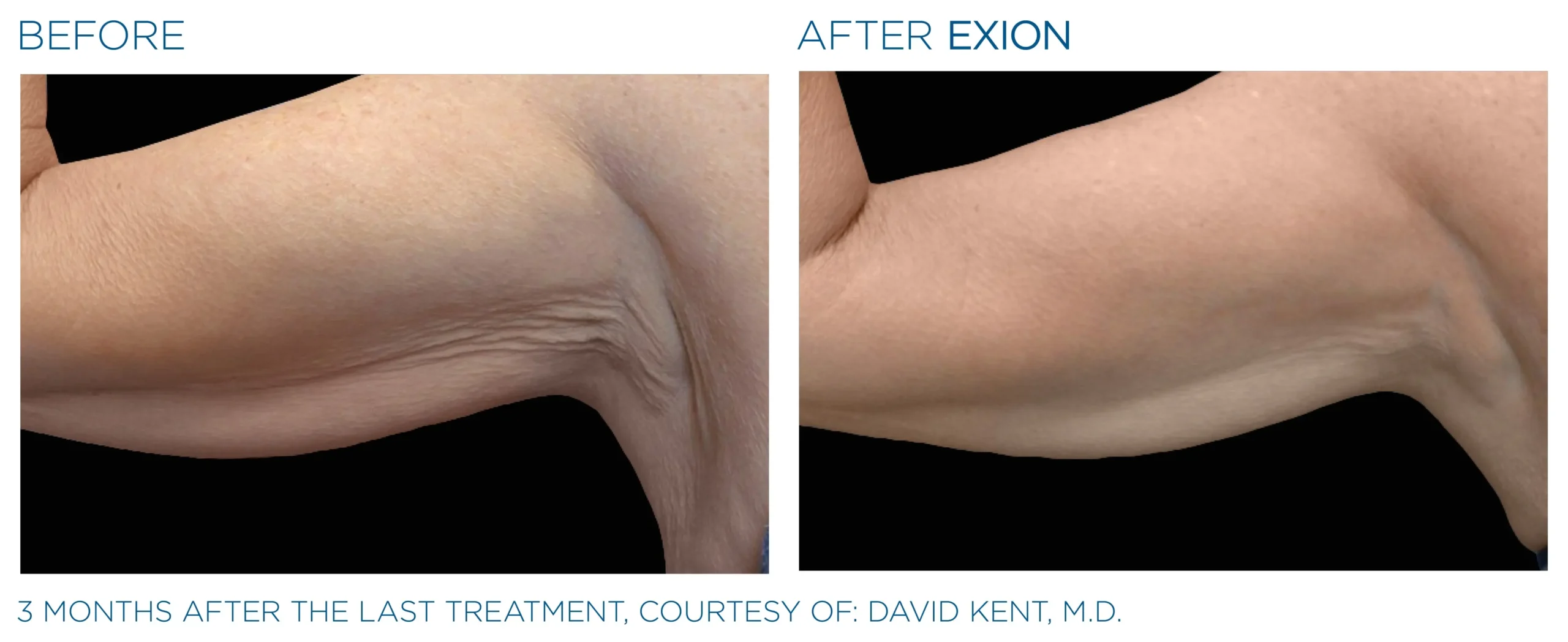 Manufacturer-provided EXION Body arm before and after treatment example
