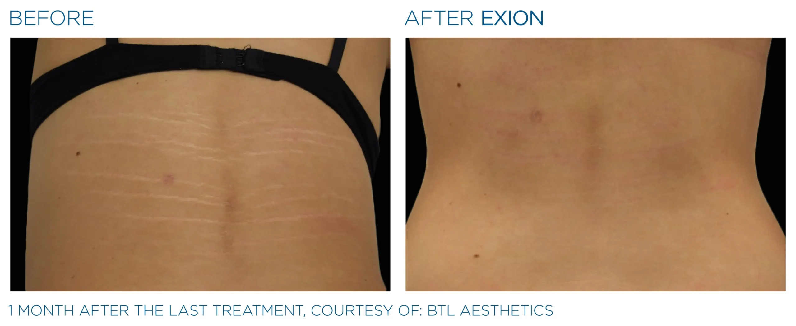 Manufacturer-provided EXION Fractional RF body before and after treatment example