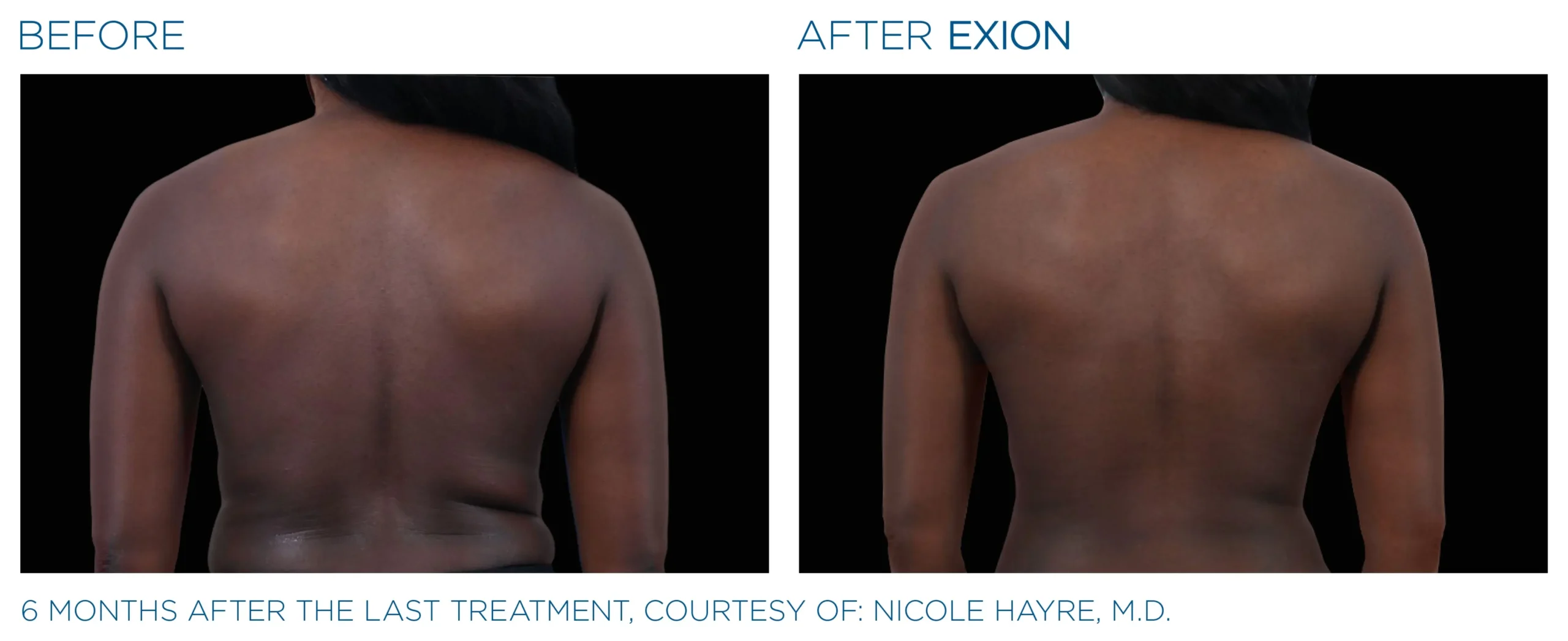 Manufacturer-provided EXION Body back before and after treatment example