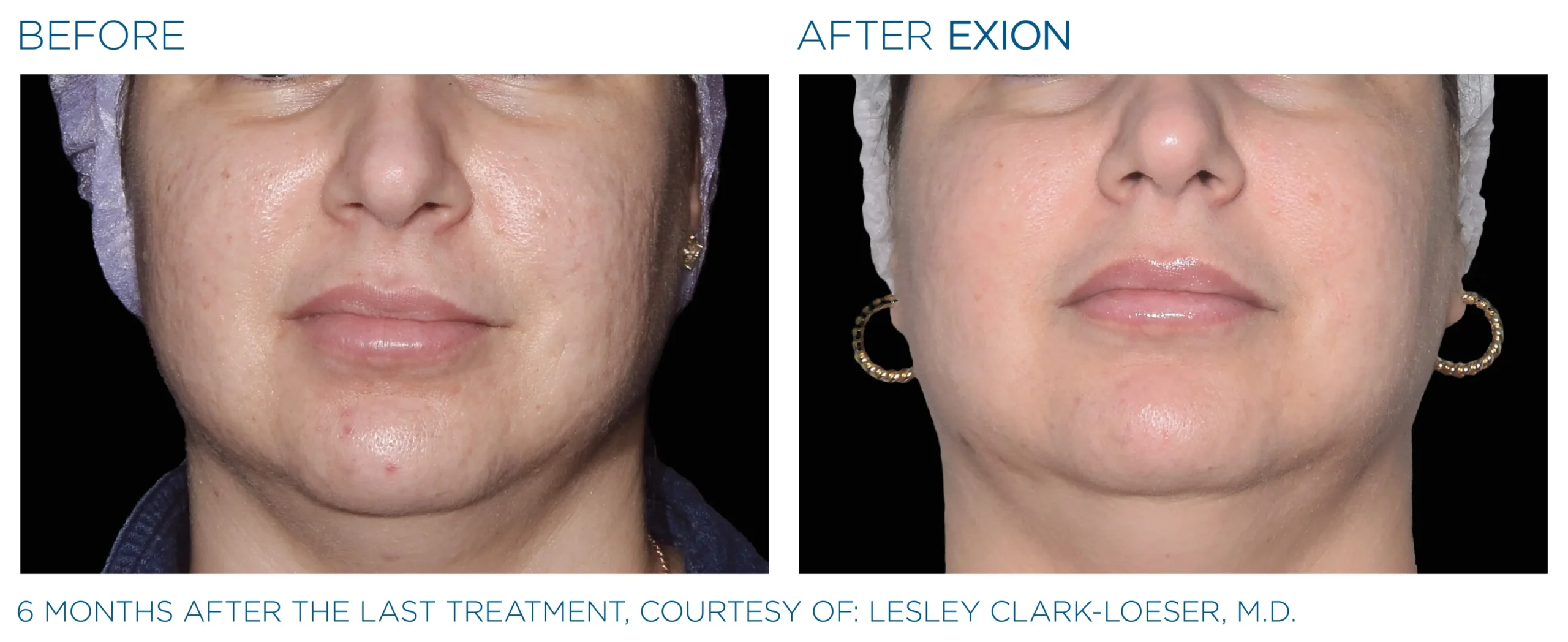 Manufacturer-provided EXION Fractional RF cheek before and after treatment example