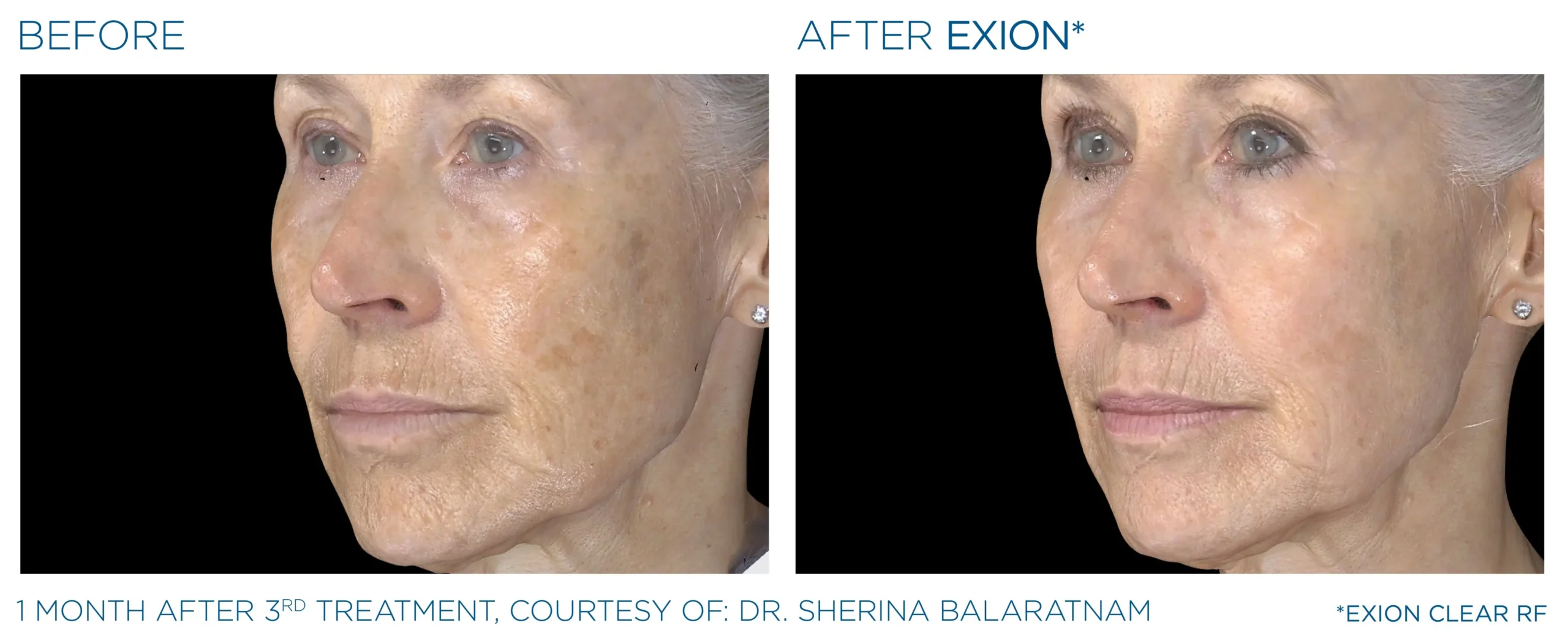 Manufacturer-provided EXION Clear RF before and after treatment example