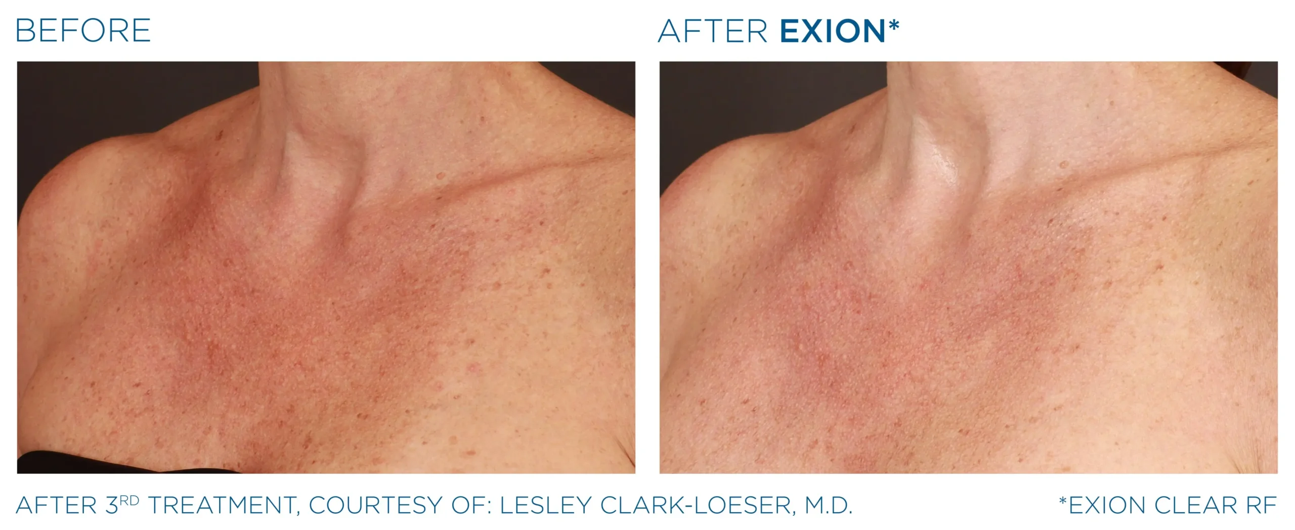 Manufacturer-provided EXION Clear RF chest before and after treatment example