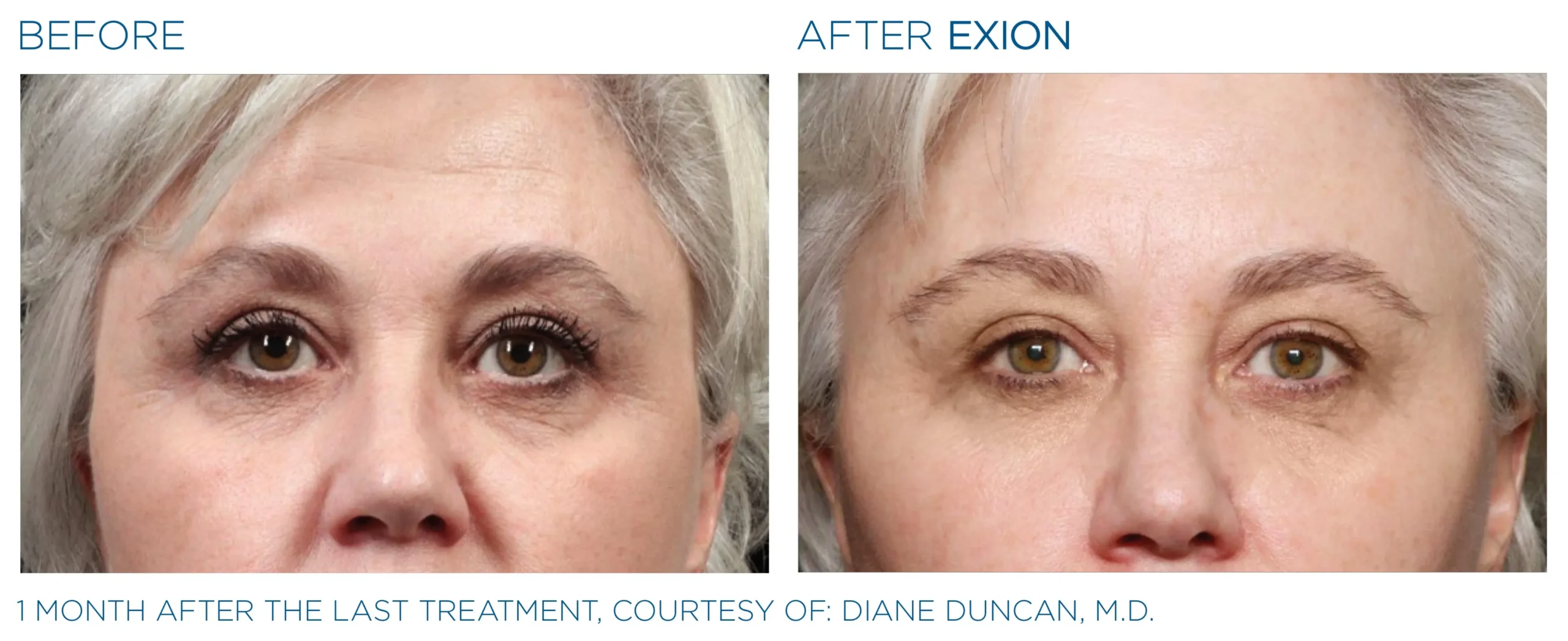 Manufacturer-provided EXION Fractional RF eye-area before and after treatment example