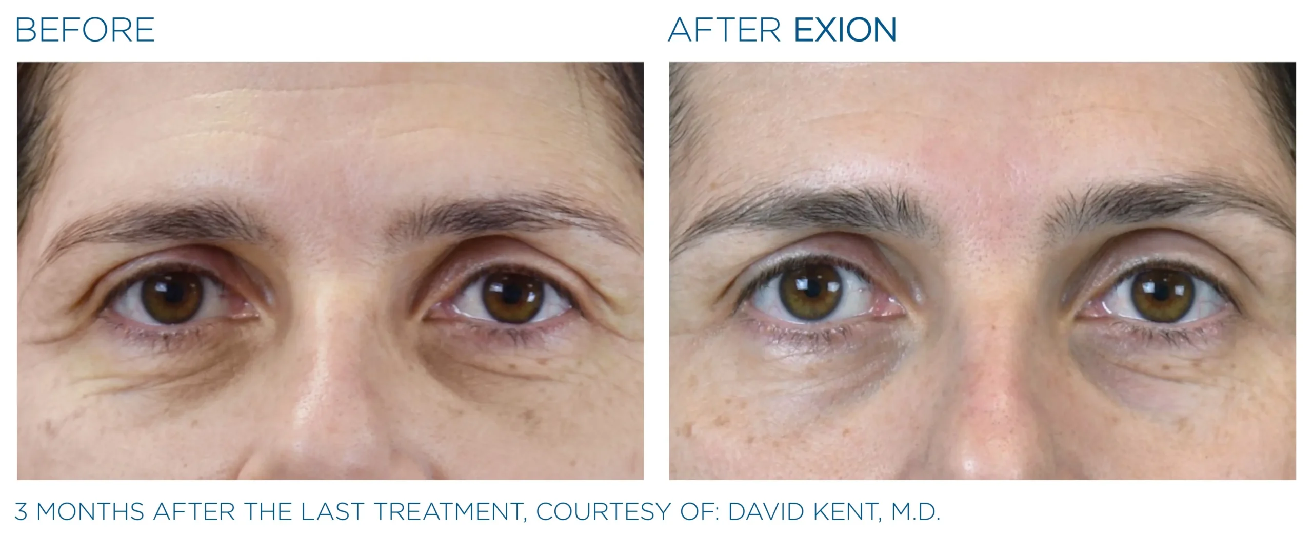 Manufacturer-provided EXION Face eye-area before and after treatment example