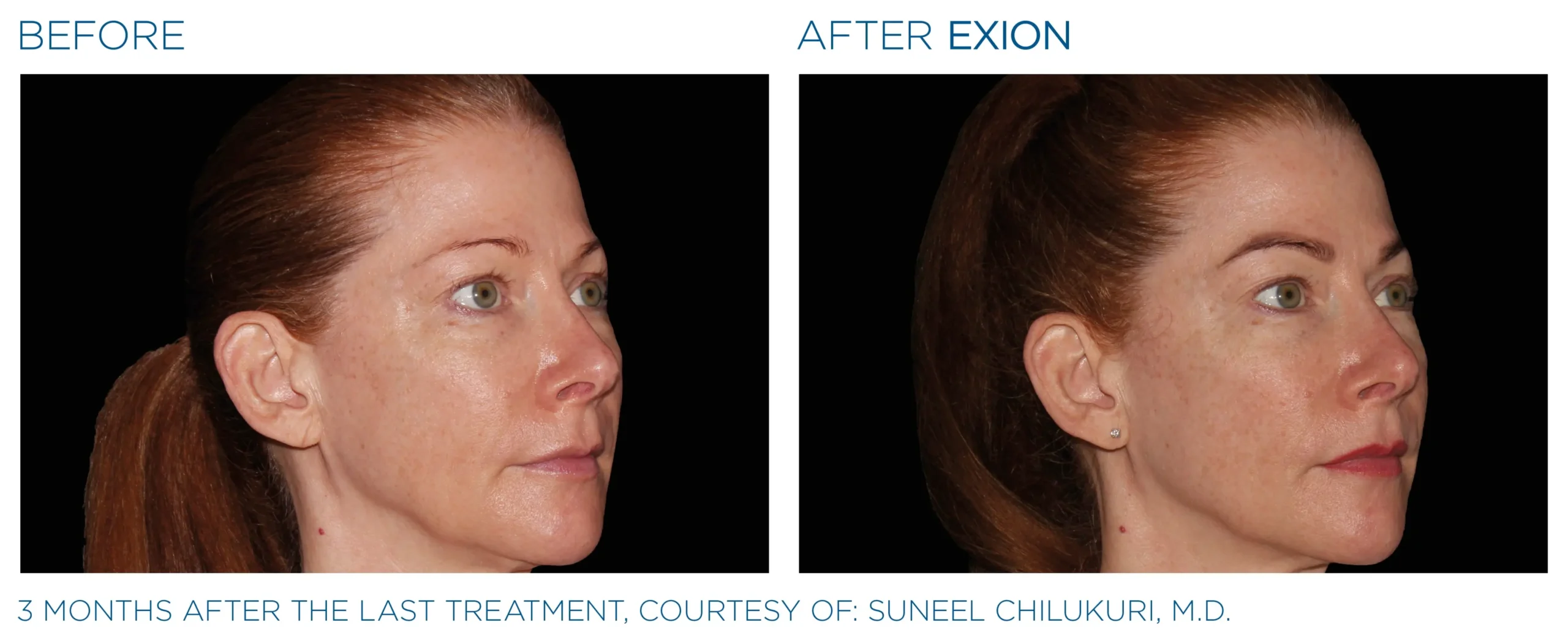 Manufacturer-provided EXION Face full-face before and after treatment example