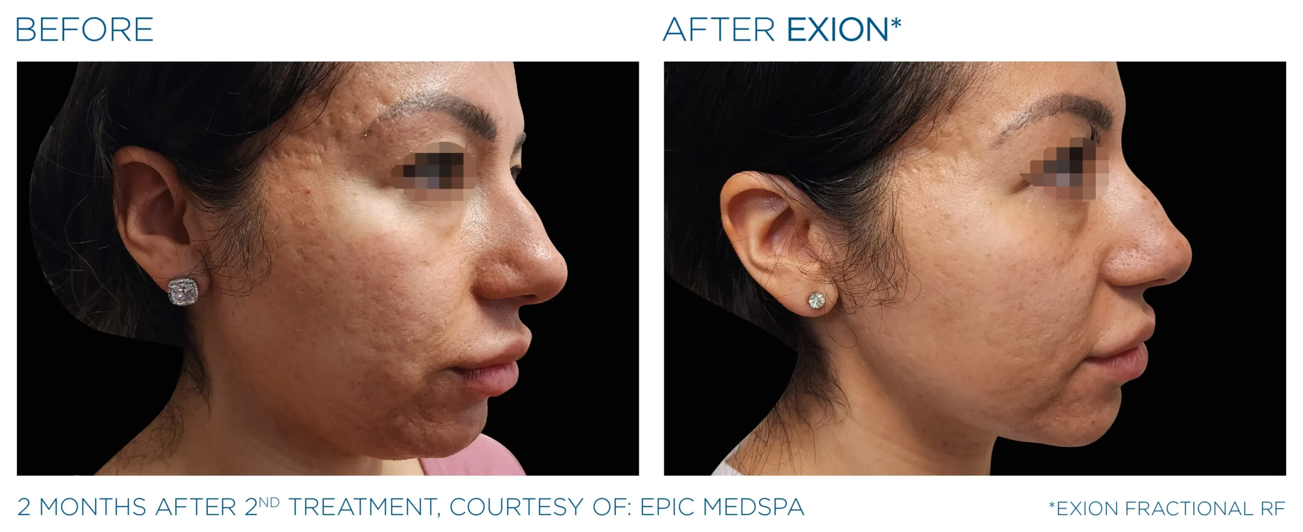 Manufacturer-provided EXION Fractional RF face before and after result example