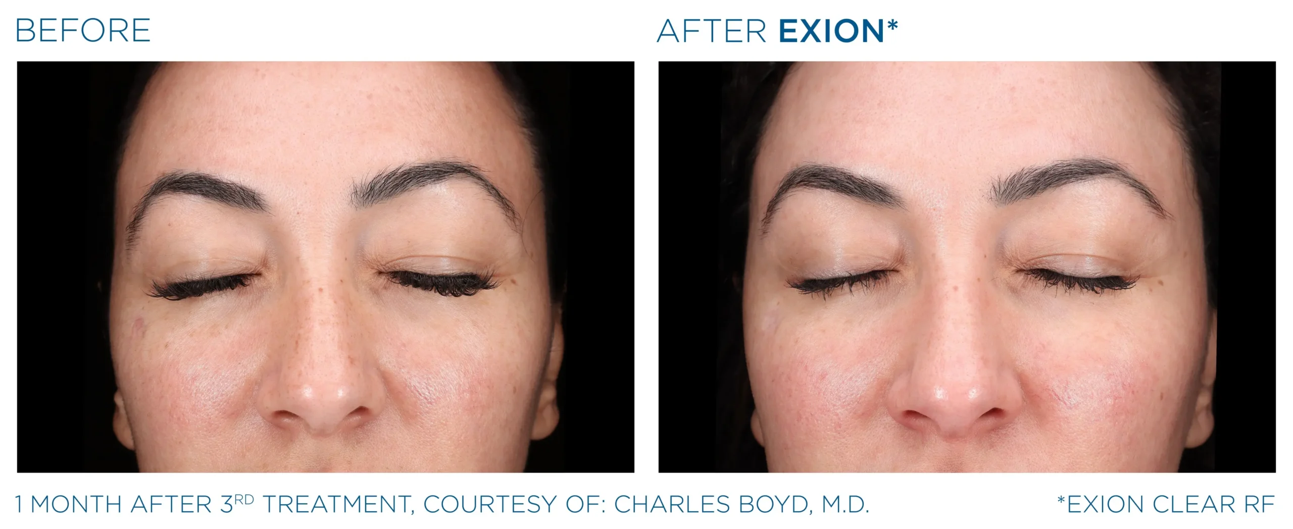 Manufacturer-provided EXION Clear RF face before and after treatment example