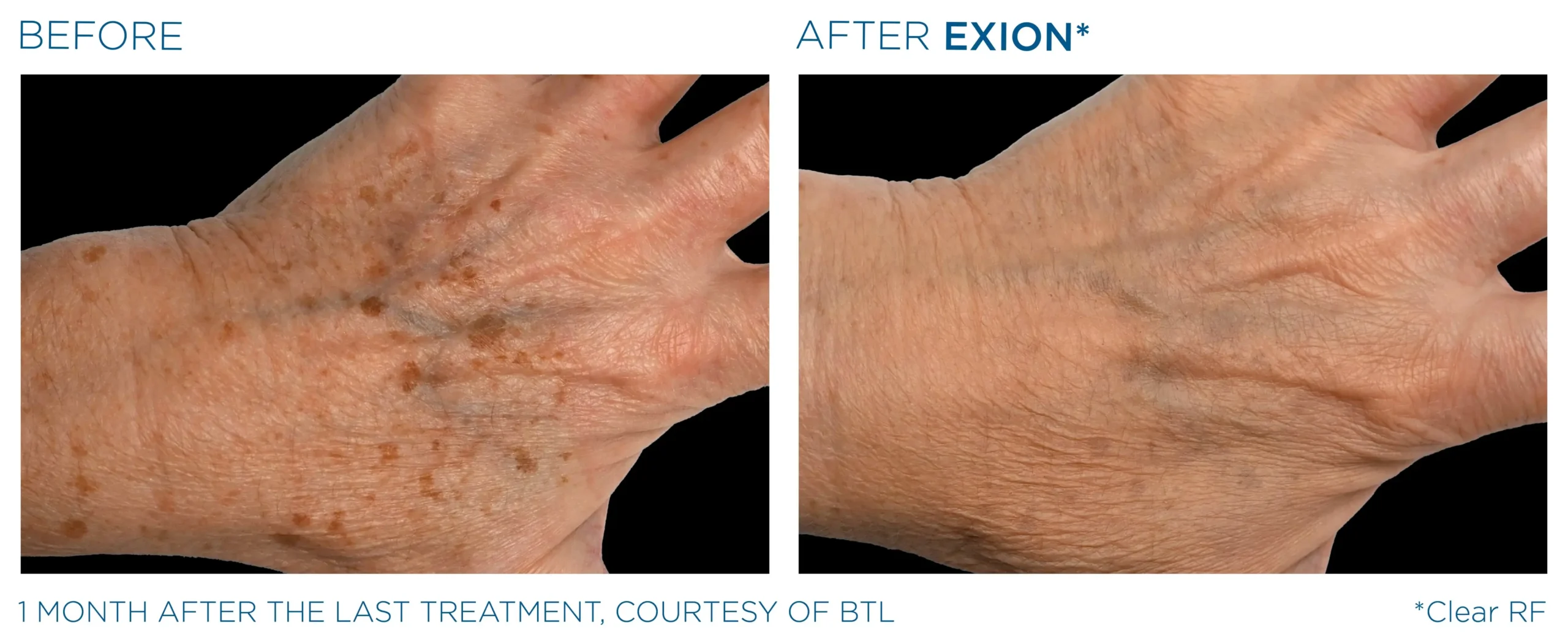 Manufacturer-provided EXION Clear RF hand before and after treatment example