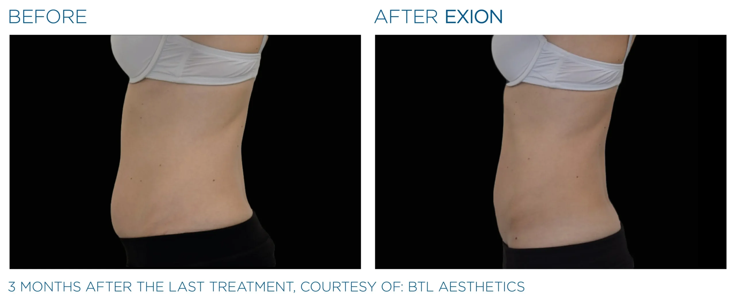 Manufacturer-provided EXION Body lateral abdomen before and after treatment example
