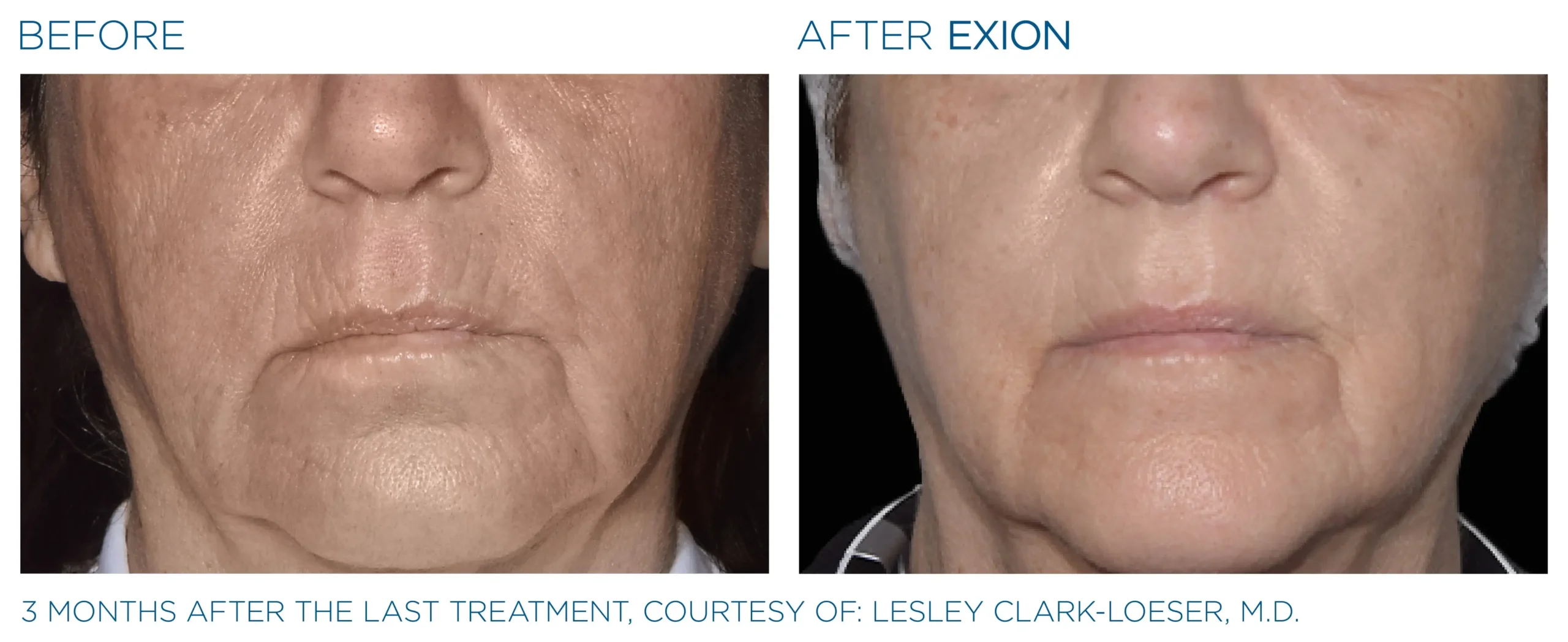 Manufacturer-provided EXION Face mouth-area before and after treatment example