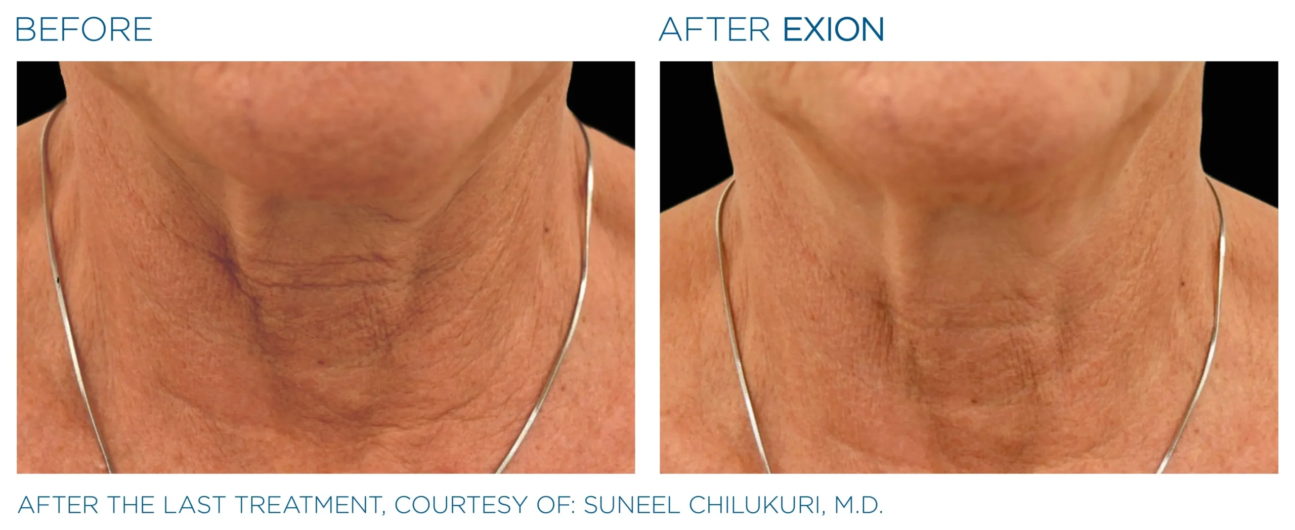 Manufacturer-provided EXION Face neck before and after result example