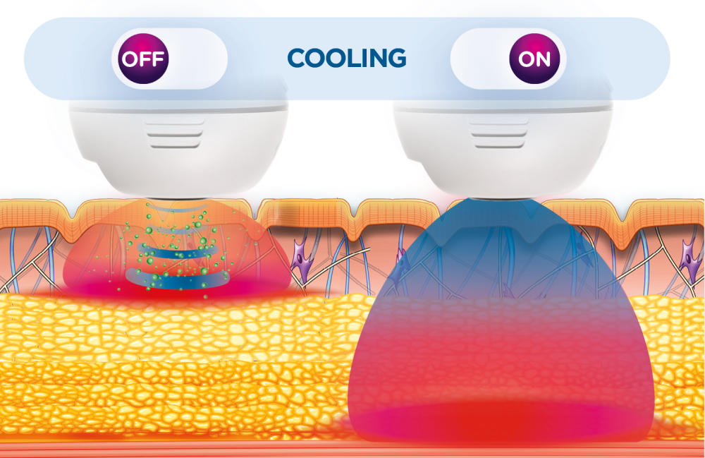 EXION Body applicator mechanism of action graphic