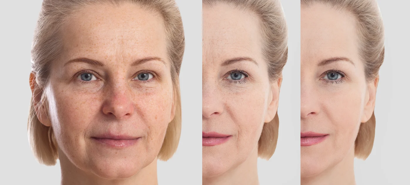 Three-panel facial skin comparison image illustrating skin rejuvenation