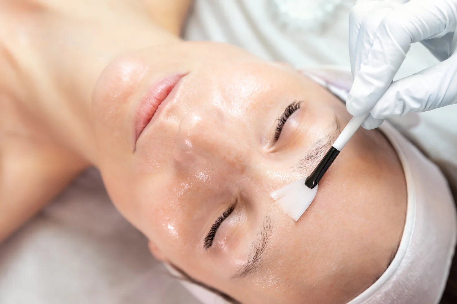 Professional chemical peel treatment at NoCo MedSpa